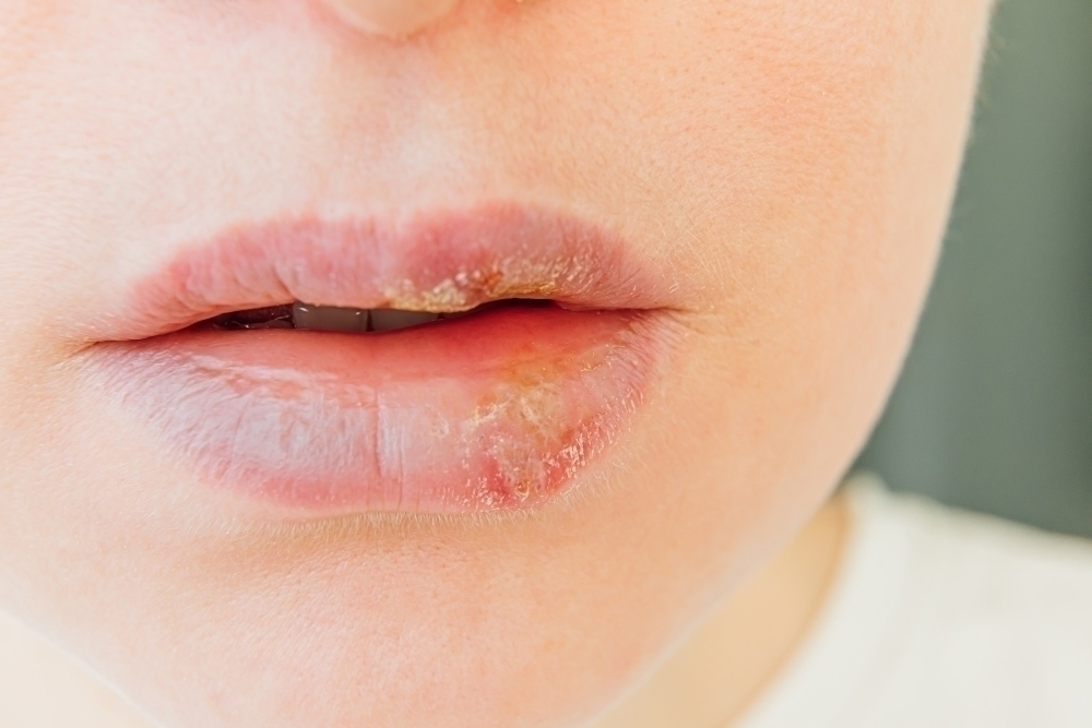 tjej-med-herpes-pa-lapparna