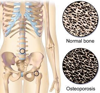osteoporosis